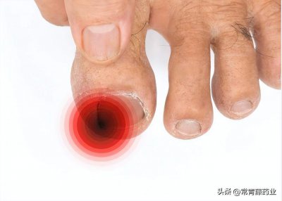 ​我得甲沟炎怎么办 我得甲沟炎了怎么办图片
