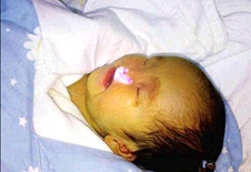 出生28天被老鼠咬掉鼻子的女婴，求职屡碰壁，现生活成这样