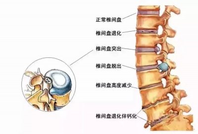 ​腰椎间盘突出症康复知识大全，收藏好了！(附示例图)