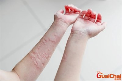 ​荨麻疹图片和症状 荨麻疹的症状和治疗