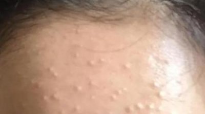 ​闭口痘痘不挤出来是不是不会消除(闭口粉刺不挤自己会消掉吗)