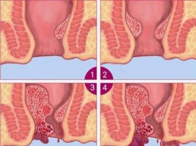 ​十几年痔疮怎么治疗(十几年的痔疮能治好吗)