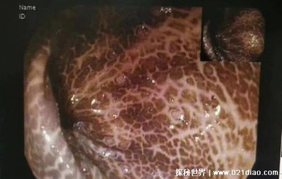 ​吃酵素肠子发黑是什么原因 正规酵素是没有问题的