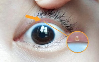 ​眼皮边缘突然长了个“小泡”，到底是怎么来的？