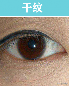 ​如何去除细纹和皱纹（干纹细纹和皱纹的区别？怎么去除干纹细纹皱纹的小妙招（