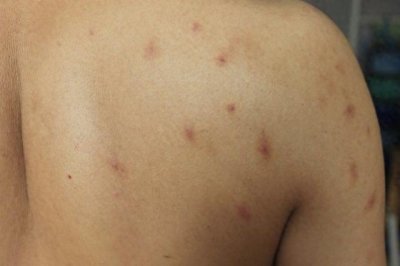 ​学生宿舍闹臭虫 住校生频被咬却无计可施