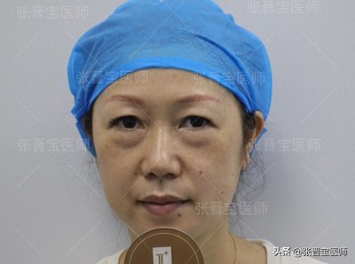 ​46岁把眼袋手术给做了，术后17天成这样，前后对比像两人