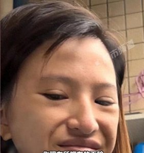 ​整容风险警示！女子花7万去高颧骨，结果后悔不已！