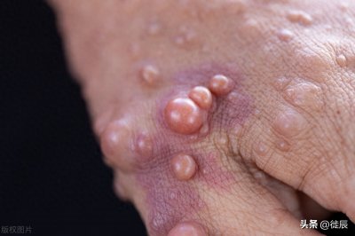 ​体表肿瘤之神经纤维瘤