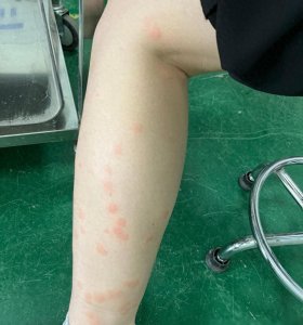 ​已到蠓虫高发期！青岛很多人中招，不少人被咬：痒到崩溃